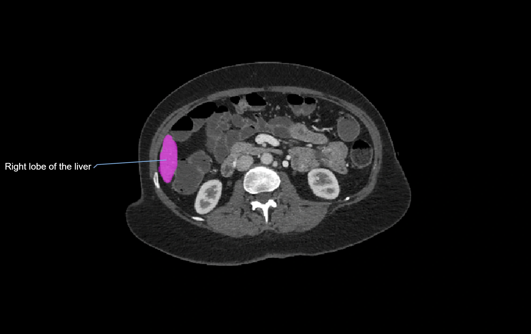 CT lliver lobes axial cross sectional anatomy labelled image -00009.webp